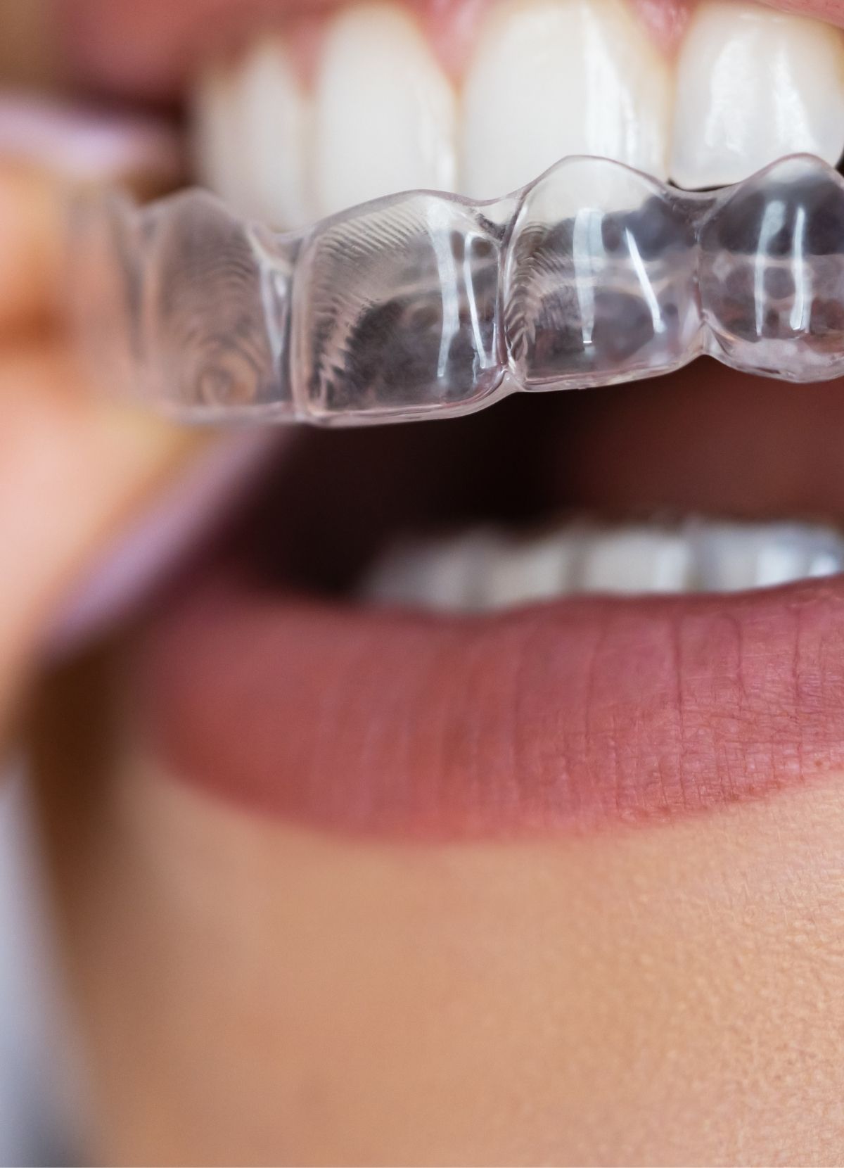 https://tolgatorun.com/wp-content/uploads/2024/12/mahmutlar-dis-klinigi-seffaf-plak-Invisalign-tedavisi.jpg